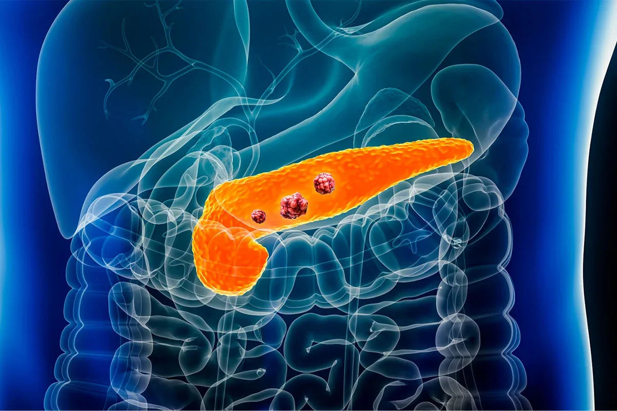 Nuevo fármaco oral duplica la supervivencia en cáncer de páncreas metastásico